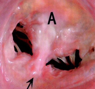 mitral-clip